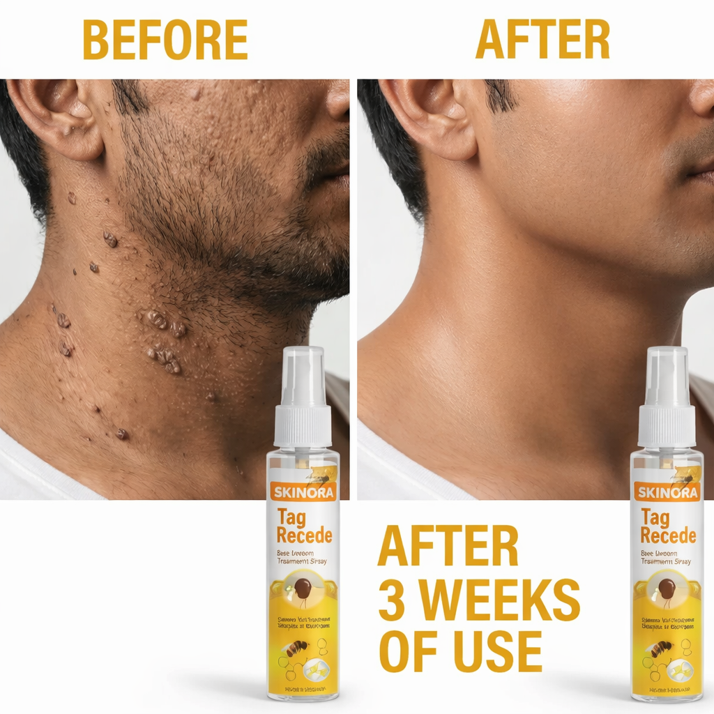 Skinora - Advanced Skin Tag Remover (Pack of 2)